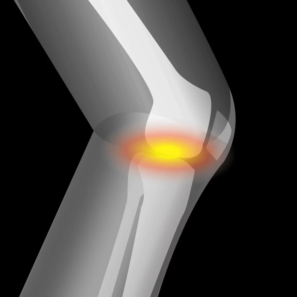 Kniegelenk mit Schmerz durch Plicasyndrom