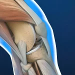 Kniegelenk mit Darstellung der Kniescheibe und der Patellasehne. Patellaspitzensyndrom