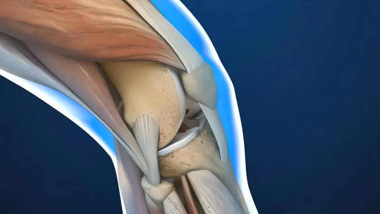 Kniegelenk mit Darstellung der Kniescheibe und der Patellasehne. Patellaspitzensyndrom